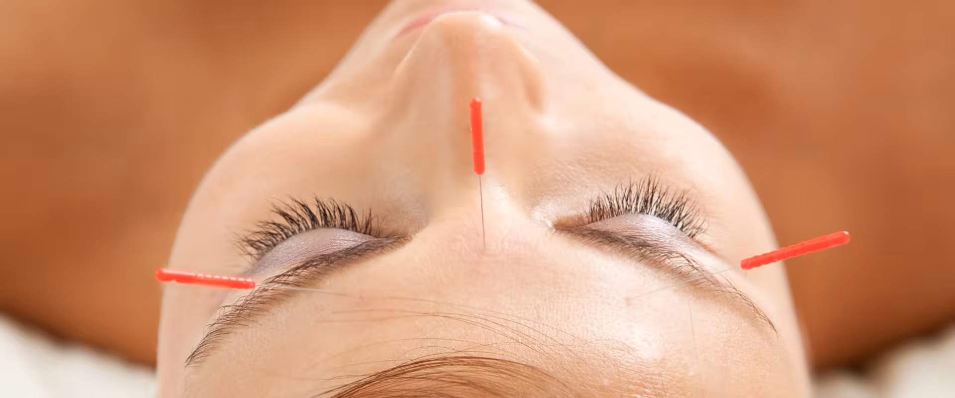 Terapeuta especializado do Instituto Ahau aplicando acupuntura com agulhas em pontos meridianos, demonstrando tratamento de Medicina Tradicional Chinesa para equilíbrio energético, alívio de dor e bem-estar integral